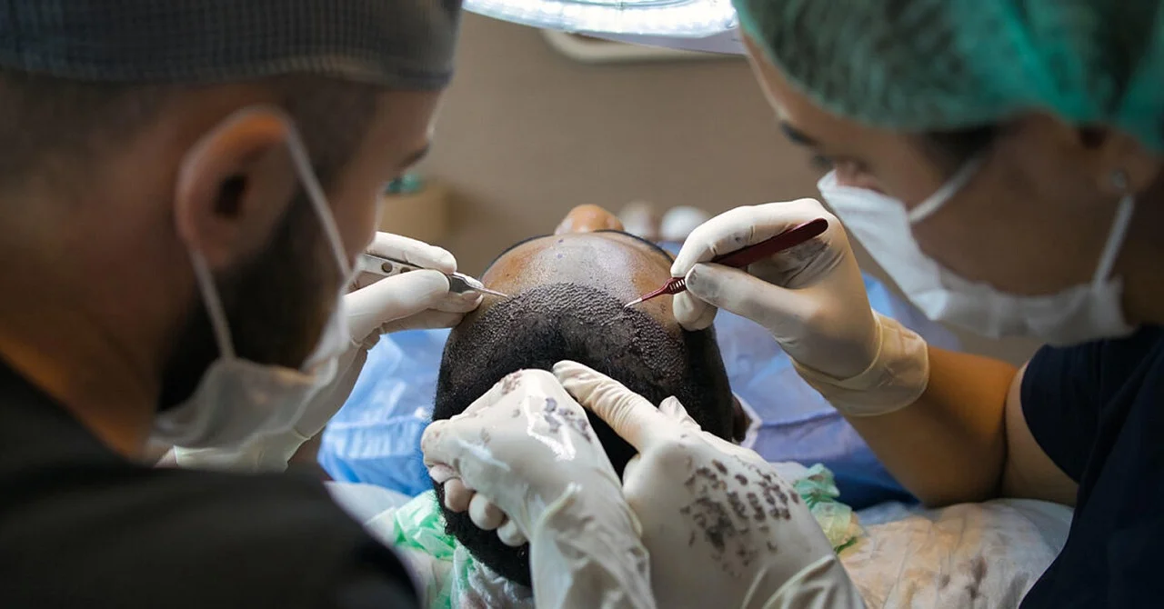 Controversial Claim: The Black Market for Hair Transplants in Germany Has Expanded Significantly